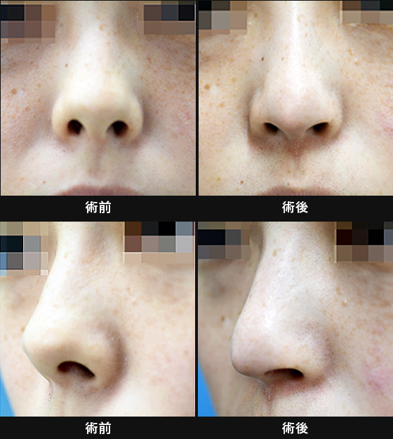 「目立つ鼻の穴・上向きの鼻（ぶた鼻）の改善症例｜鼻中隔延長術＋鼻孔縁下降術」の症例写真・画像・ビフォーアフター
