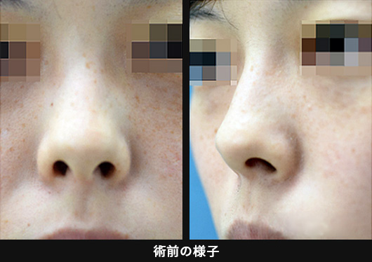 「鼻の穴をできるだけ目立たなくしたい」の症例写真・画像・ビフォーアフター