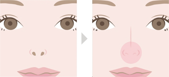 鼻孔縁下降術