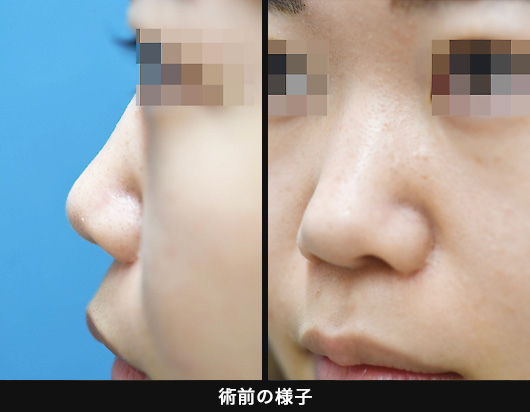 「鼻スジを高く細くしたい」の症例写真・画像・ビフォーアフター