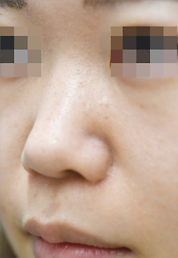 立体感のある顔立ちにビフォー