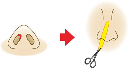 鼻プロテーゼの施術について