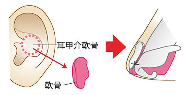 鼻中隔延長術の施術について