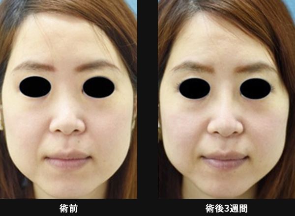 「鼻スジを通して顔立ちにメリハリを出す（プロテーゼ挿入）」の症例写真・画像・ビフォーアフター