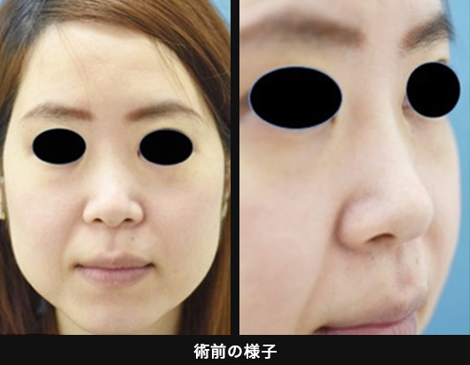 「鼻スジを通して顔立ちにメリハリを出す（プロテーゼ挿入）」の症例写真・画像・ビフォーアフター