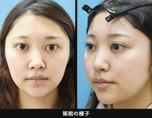 鼻全体を控え目な印象にかえる「忘れ鼻整形」の症例写真・画像・ビフォーアフター