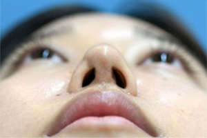 術後