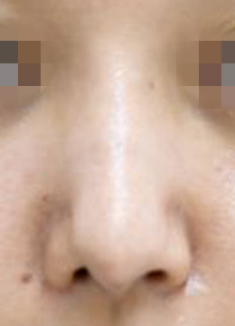 術後