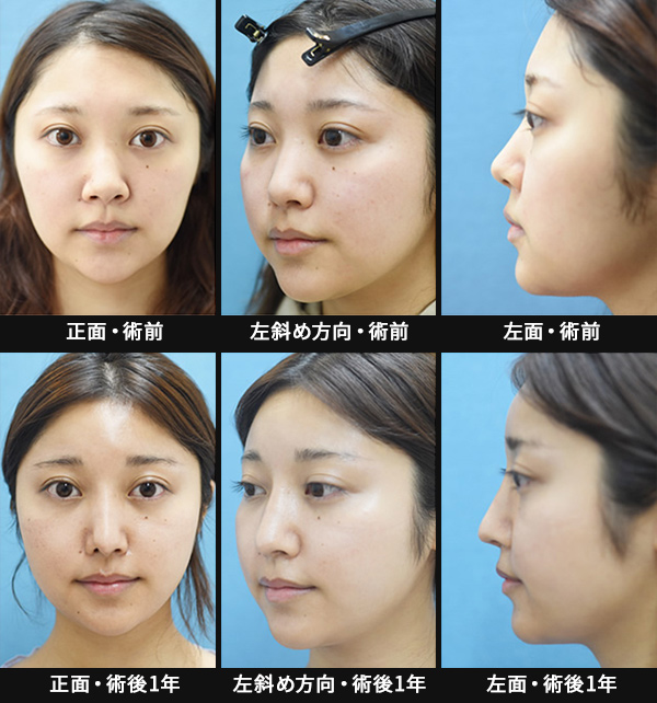 鼻全体を控え目な印象にかえる「忘れ鼻整形」の症例写真・画像・ビフォーアフター