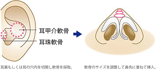 鼻尖耳介軟骨移植の施術イメージ
