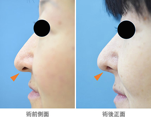 鼻柱挙上術の症例写真・画像・ビフォーアフター