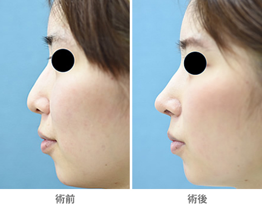 鼻中隔延長術の症例写真・画像・ビフォーアフター