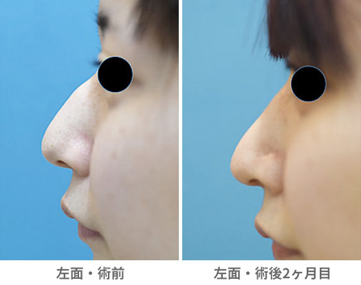 鼻尖挙上術＋ハンプ除去の症例写真・画像・ビフォーアフター