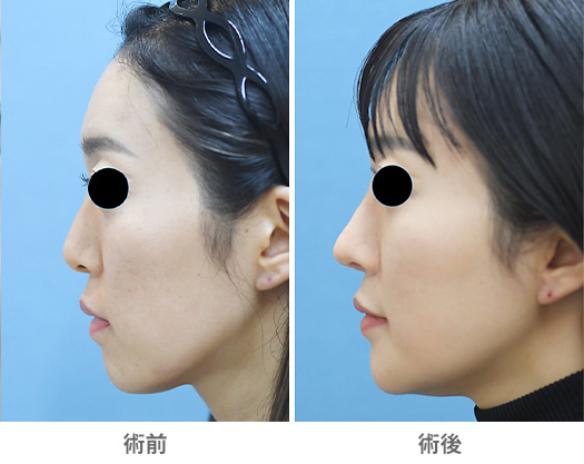 カスタマイズ手術の一例（鼻整形＋輪郭整形）の症例写真・画像・ビフォーアフター