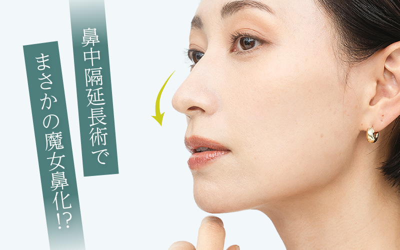 鼻中隔延長後に魔女鼻化！？失敗リスクの解説