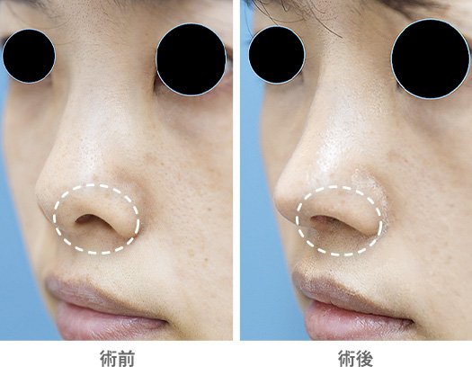 前方・斜め方向から鼻の穴を目立たなくした症例の症例写真・画像・ビフォーアフター