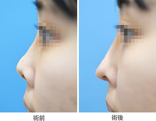 悩み別・おすすめ鼻整形と術式ガイド
