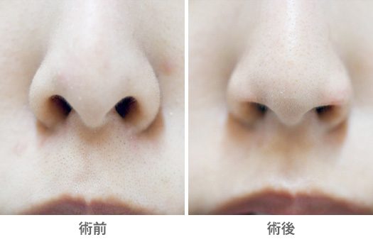 そもそも「豚鼻」とはどんな状態？