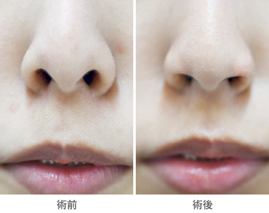 鼻の穴が目立つ・形が気になる